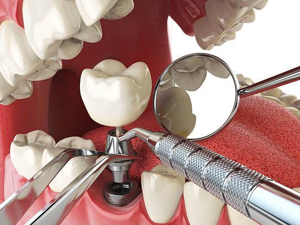 Best Emergency Wisdom Teeth Removal in Fairbanks Ranch, CA