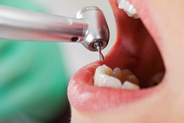 Best Emergency Treatment for Dental Infections or Abscesses in Fairbanks Ranch, CA